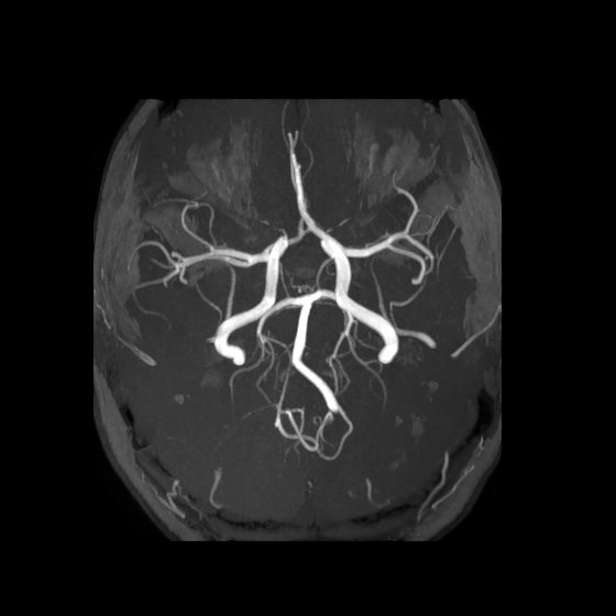 Artery of Percheron infarct (Radiopaedia 40966-43676 F 21).jpg