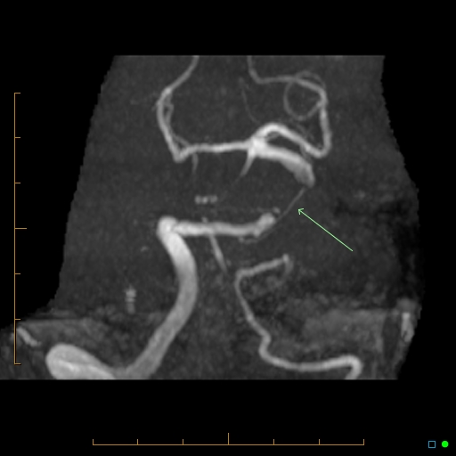 File:Artifactual basilar artery stenosis due to metallic stent (Radiopaedia 31206-31922 3D MIP 3).jpg