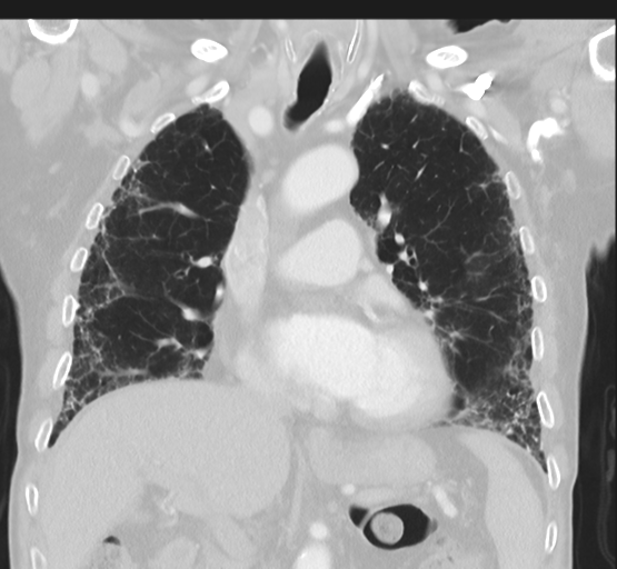 Asbestosis (Radiopaedia 56192-62864 Coronal lung window 23).png