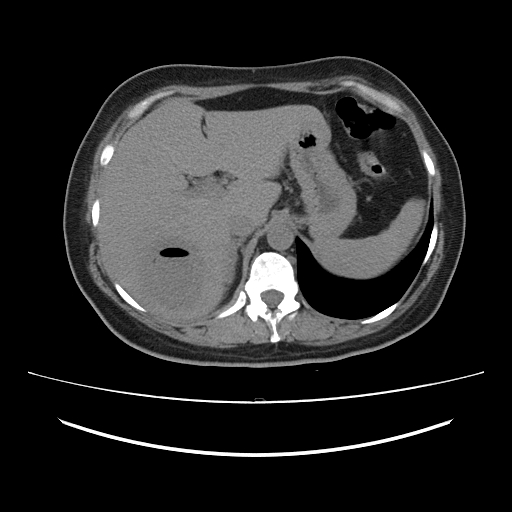 File:Ascending retrocecal appendicitis with liver abscesses (Radiopaedia 60066-67615 Axial non-contrast 20).jpg