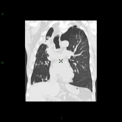 File:Aspergilloma (Radiopaedia 14842-14787 Coronal lung window 17).jpg