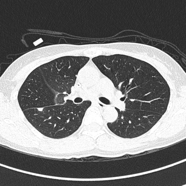 File:Aspergilloma (Radiopaedia 26223-26347 Axial lung window 34).jpg