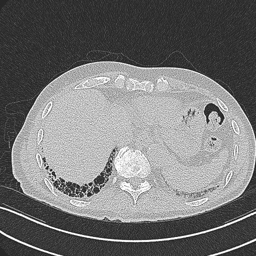 File:Aspergilloma on background pulmonary fibrosis (Radiopaedia 60942-68757 B 44).jpg