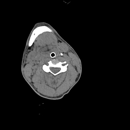 File:Atlanto-occipital dissociation (Traynelis type 1), C2 teardrop fracture, C6-7 facet joint dislocation (Radiopaedia 87655-104061 Axial non-contrast 40).jpg
