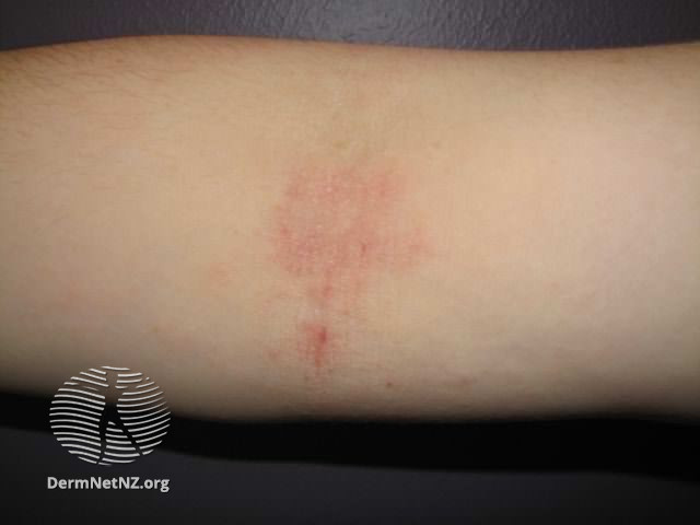 File:Atopic dermatitis (DermNet NZ dermatitis-flexural-eczema19).jpg