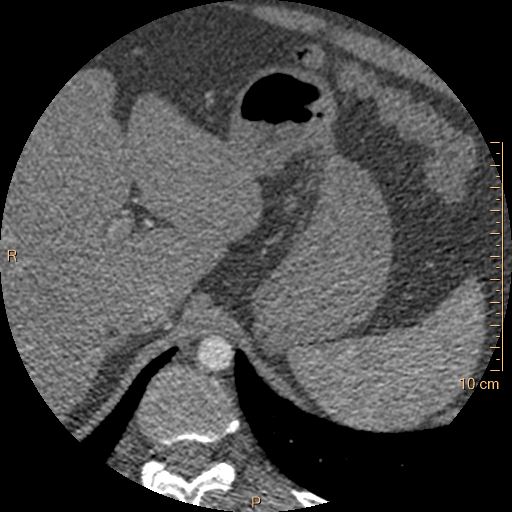 Atrial septal defect (upper sinus venosus type) with partial anomalous pulmonary venous return into superior vena cava (Radiopaedia 73228-83961 A 317).jpg