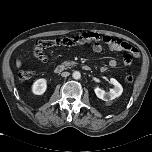 Atypical hepatocellular carcinoma (Radiopaedia 41744-44698 B 50).jpg
