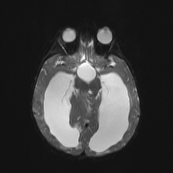 Atypical medulloblastoma (Radiopaedia 34903-36371 Axial DWI 13).jpg