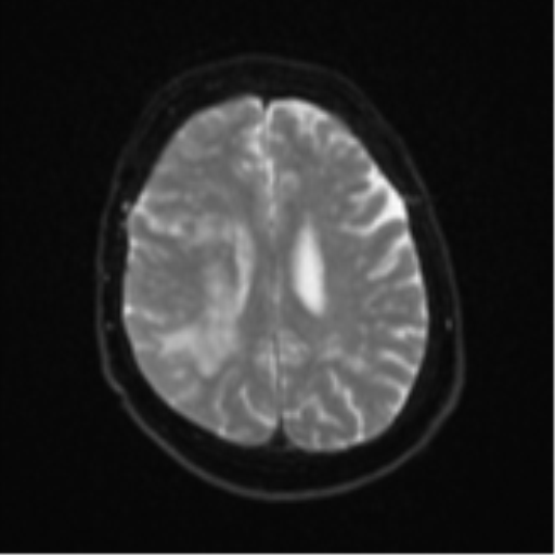 Atypical meningioma (WHO Grade II) (Radiopaedia 54742-60979 Axial DWI 19).png