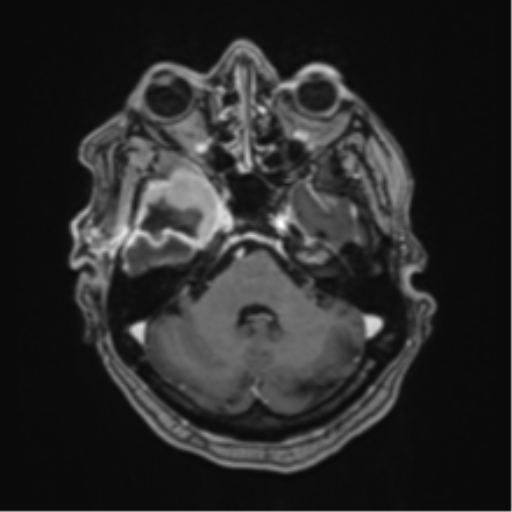 Atypical meningioma (WHO Grade II) (Radiopaedia 54742-60981 Axial T1 C+ 17).png
