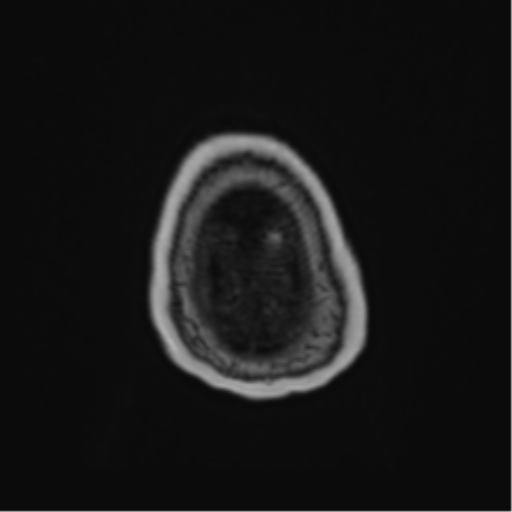 File:Atypical meningioma (WHO Grade II) (Radiopaedia 54742-60981 Axial T1 C+ 69).png