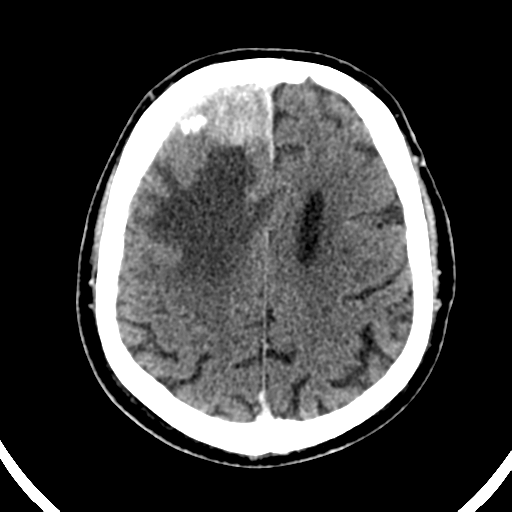 Atypical meningioma (WHO grade II) with brain invasion (Radiopaedia 57767-64728 Axial C+ 17).png