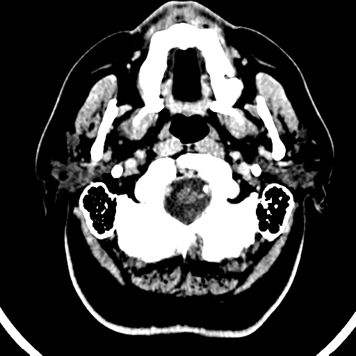 File:Atypical meningioma (WHO grade II) with brain invasion (Radiopaedia 57767-64728 Axial C+ 53).png