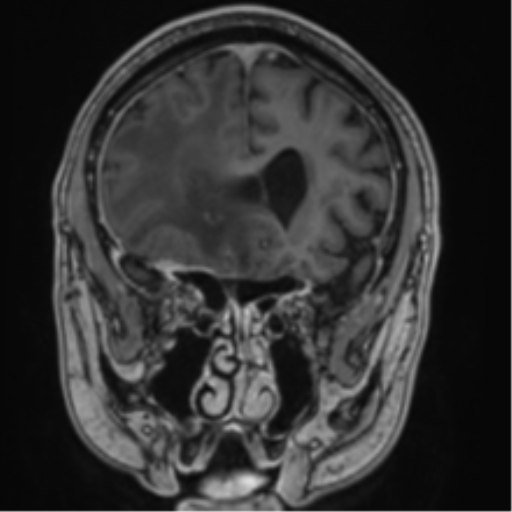 File:Atypical meningioma (WHO grade II) with brain invasion (Radiopaedia 57767-64729 Coronal T1 C+ 25).png