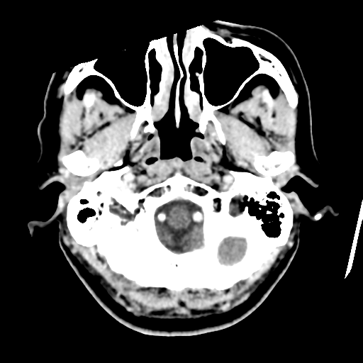 Atypical meningioma (WHO grade II) with osseous invasion (Radiopaedia 53654-59715 Axial C+ delayed 8).png