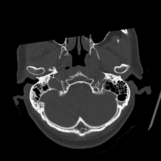 Atypical meningioma with skull invasion (Radiopaedia 34357-35649 Axial bone window 14).png