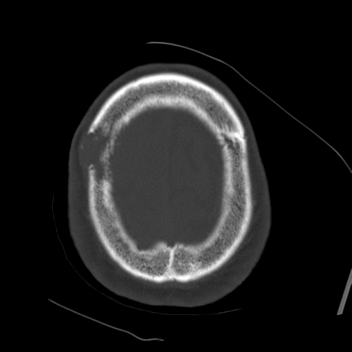 Atypical meningioma with skull invasion (Radiopaedia 34357-35649 Axial bone window 71).png