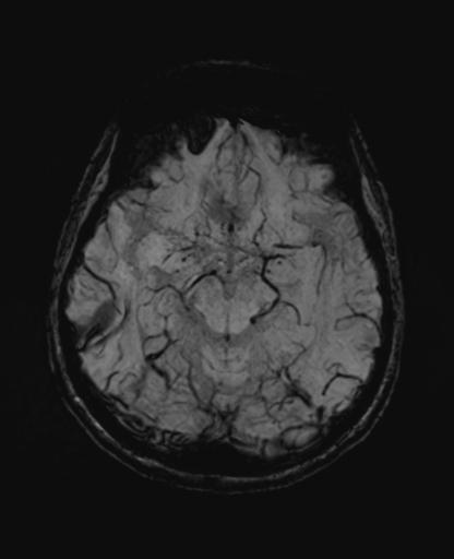 File:Autoimmune limbic encephalitis (Radiopaedia 30363-31005 SWI - mIP 28).jpg