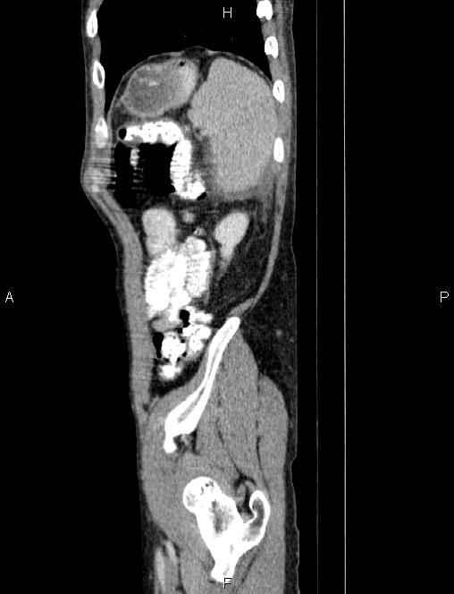 Autoimmune pancreatitis (Radiopaedia 84925-100431 E 84).jpg