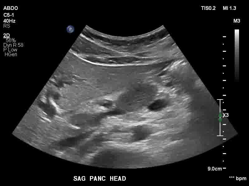 File:Autoimmune pancreatitis (Radiopaedia 88443-105100 C 14).jpg