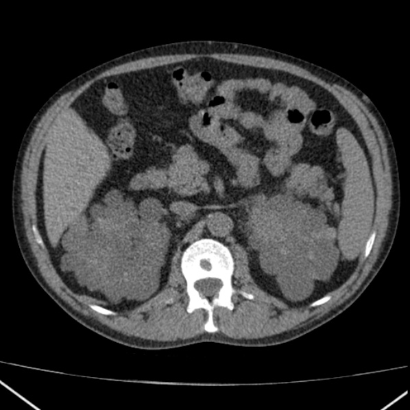 File:Autosomal dominant polycystic kidney disease (Radiopaedia 36539-38101 Axial non-contrast 31).jpg