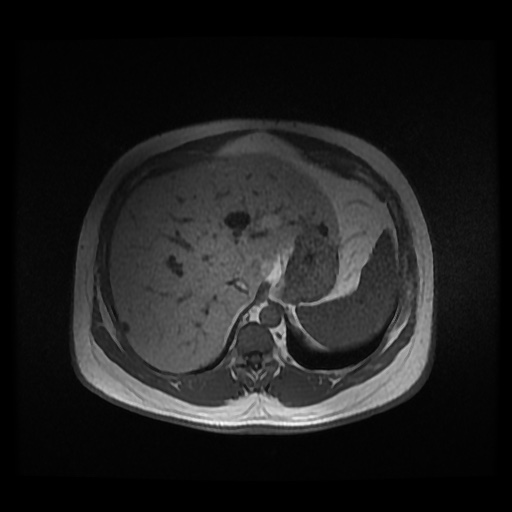 Autosomal dominant polycystic kidney disease (Radiopaedia 50259-55611 Axial 2D Dual Echo 24).jpg