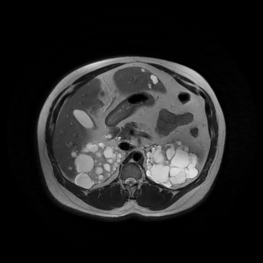 File:Autosomal dominant polycystic kidney disease (Radiopaedia 50259-55611 Axial T2 18).jpg