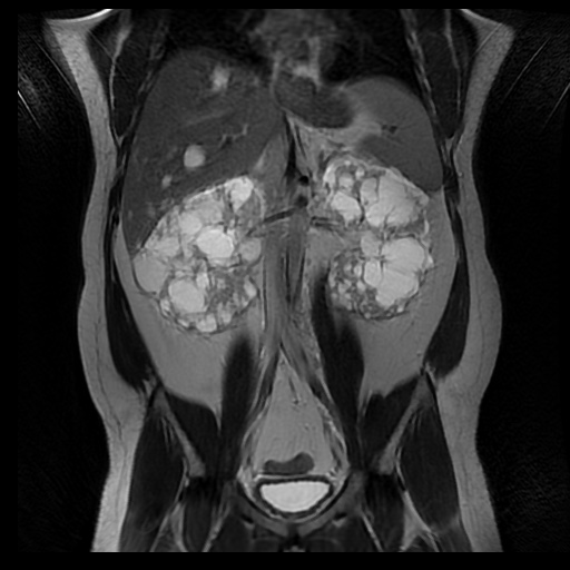 File:Autosomal dominant polycystic kidney disease (Radiopaedia 50259-55611 Coronal T2 21).jpg