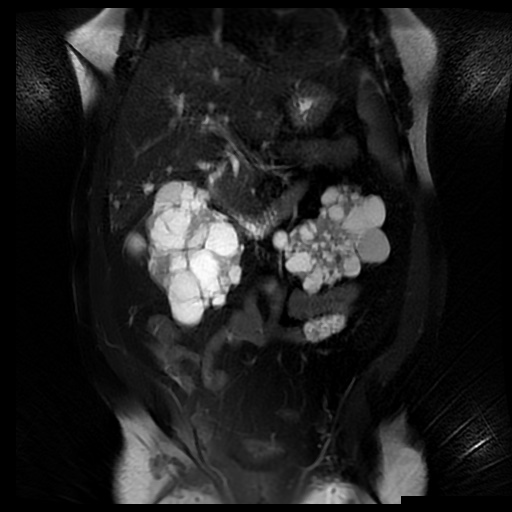 File:Autosomal dominant polycystic kidney disease (Radiopaedia 50259-55611 Coronal T2 fat sat 17).jpg