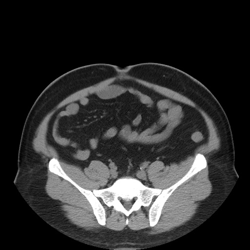 Autosomal dominant polycystic kidney disease (Radiopaedia 50259-55612 Axial non-contrast 63).jpg
