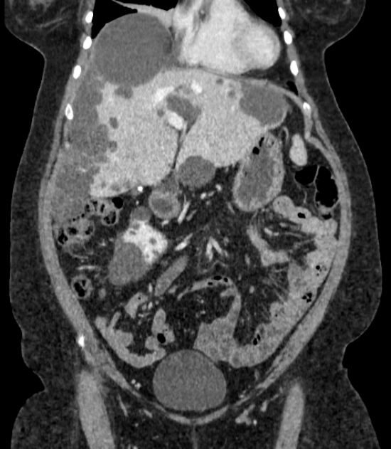 Autosomal dominant polycystic kidney disease (Radiopaedia 57124-64017 B 26).jpg