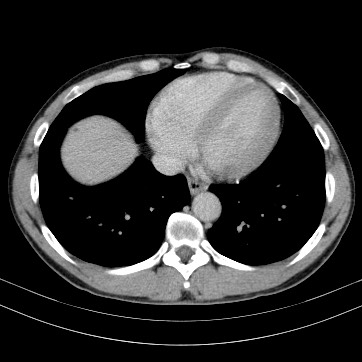 Autosomal dominant polycystic kidney disease (Radiopaedia 66349-75582 B 2).jpg