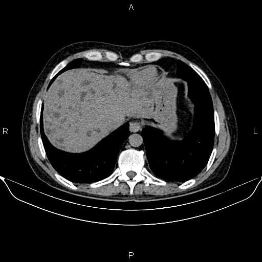 Autosomal dominant polycystic kidney disease (Radiopaedia 87830-104287 Axial non-contrast 9).jpg