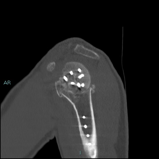 Avascular necrosis after fracture dislocations of the proximal humerus (Radiopaedia 88078-104653 Sagittal bone window 24).jpg