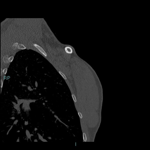 Avascular necrosis after fracture dislocations of the proximal humerus (Radiopaedia 88078-104655 Coronal bone window 142).jpg
