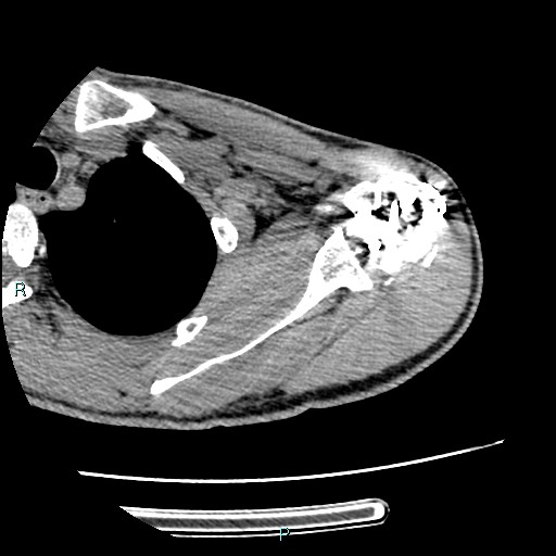 File:Avascular necrosis after fracture dislocations of the proximal humerus (Radiopaedia 88078-104655 D 46).jpg