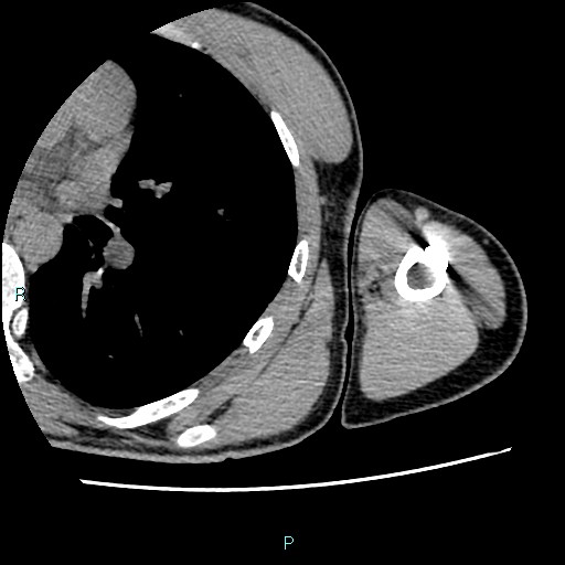 File:Avascular necrosis after fracture dislocations of the proximal humerus (Radiopaedia 88078-104655 D 95).jpg