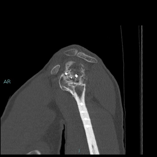 Avascular necrosis after fracture dislocations of the proximal humerus (Radiopaedia 88078-104655 Sagittal bone window 24).jpg