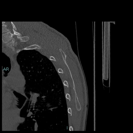 Avascular necrosis after fracture dislocations of the proximal humerus (Radiopaedia 88078-104655 Sagittal bone window 83).jpg