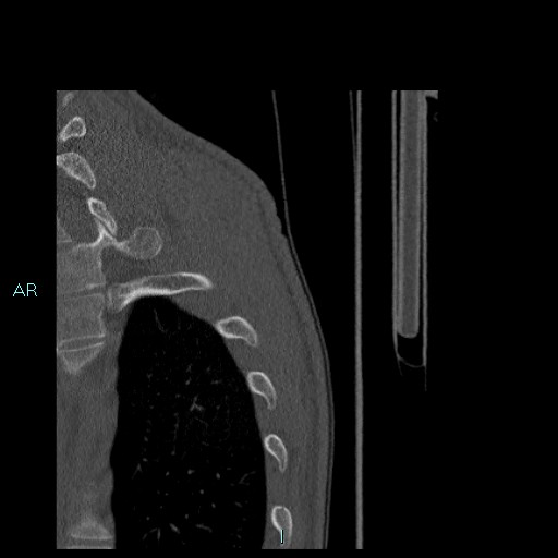 Avascular necrosis after fracture dislocations of the proximal humerus (Radiopaedia 88078-104655 Sagittal bone window 97).jpg