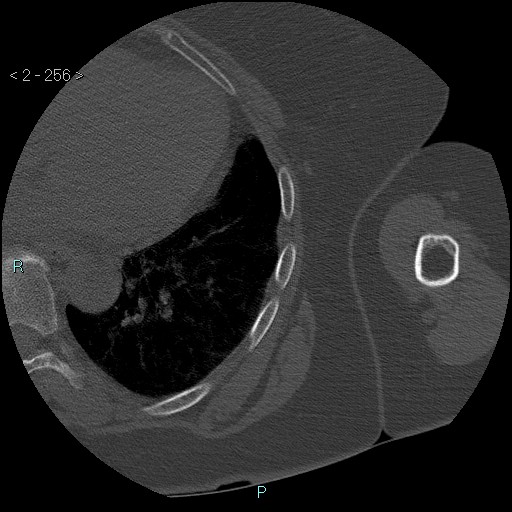 File:Avascular necrosis of the shoulder - Cruess stage I (Radiopaedia 77674-89887 Axial bone window 64).jpg