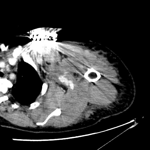 File:Axillary arterial pseudoaneurysm (Radiopaedia 24925-25195 A 9).jpg