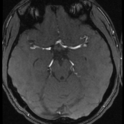 Azygos anterior cerebral artery (Radiopaedia 17059-16756 Axial MRA 42).jpg