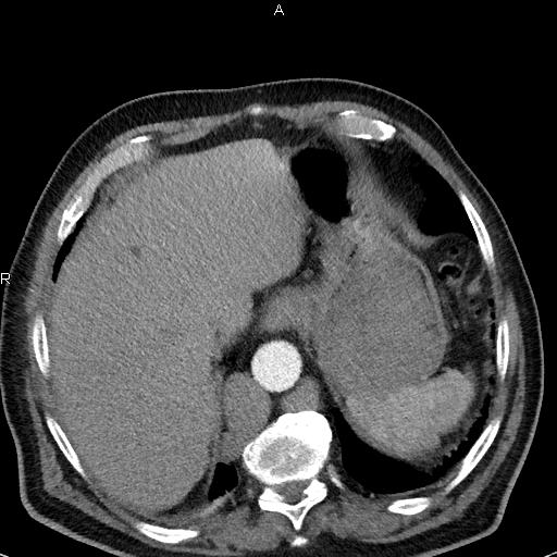 File:Azygos continuation of the inferior vena cava (Radiopaedia 18537-18404 C+ arterial phase 47).jpg