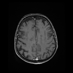 Balo concentric sclerosis (Radiopaedia 53875-59982 Axial LAVA C+ 184).jpg