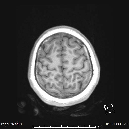 Balo concentric sclerosis (Radiopaedia 61637-69636 Axial T1 76).jpg