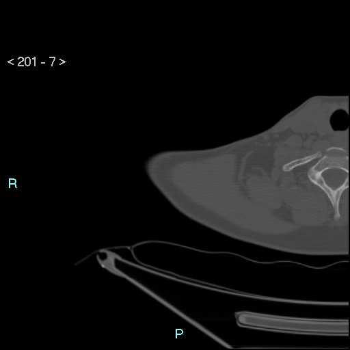 Bankart lesion with glenoid bone defect - assessment TC with PICO method (Radiopaedia 42855-93901 Axial bone window 6).jpg