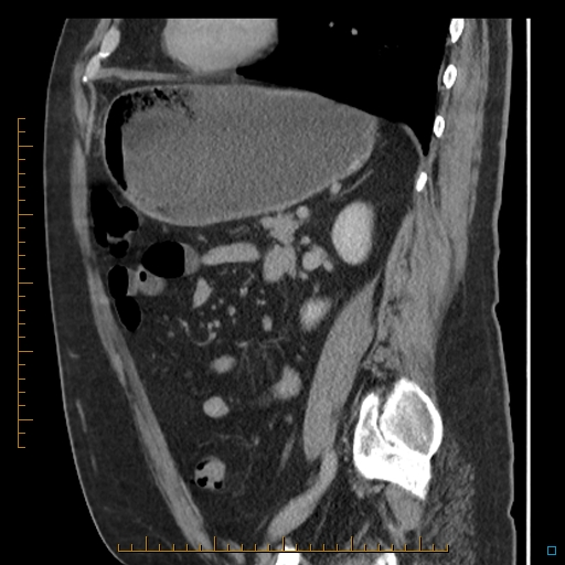 Bariatric balloon causing gastric outlet obstruction (Radiopaedia 54449-60672 C 29).jpg
