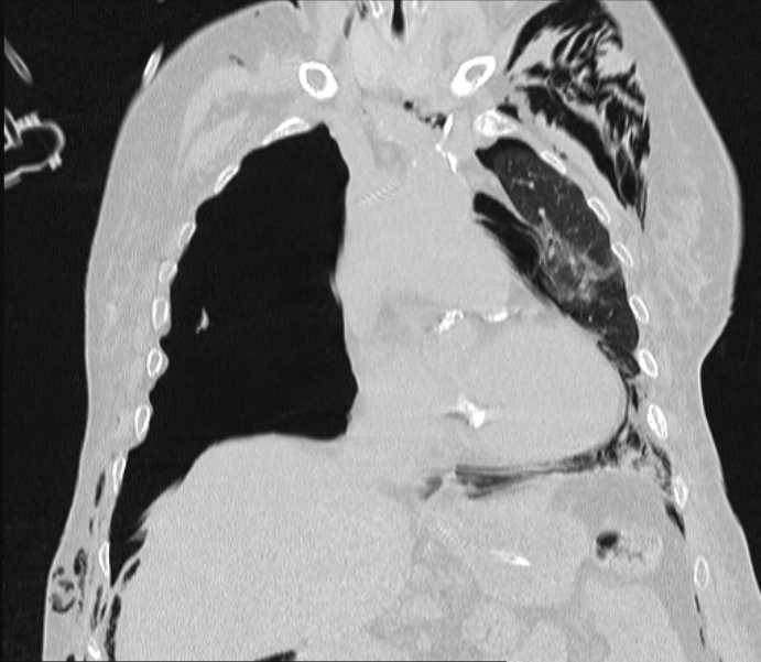 Barotrauma due to mechanical ventilation (Radiopaedia 28079-28336 Coronal lung window 43).jpg