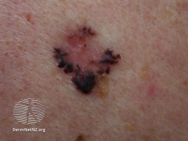 Basal cell carcinoma affecting the face (DermNet NZ lesions-bcc-face-1086).jpg